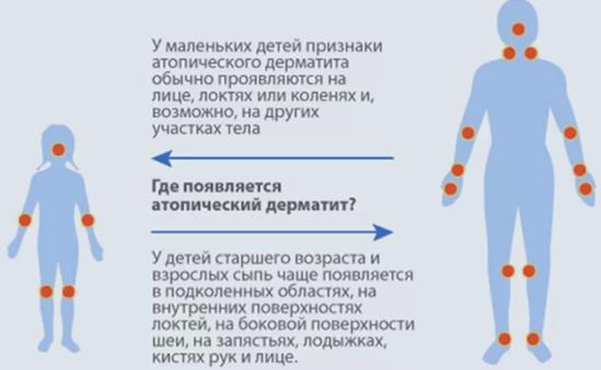 Аллергия и помощь биодобавками НСП